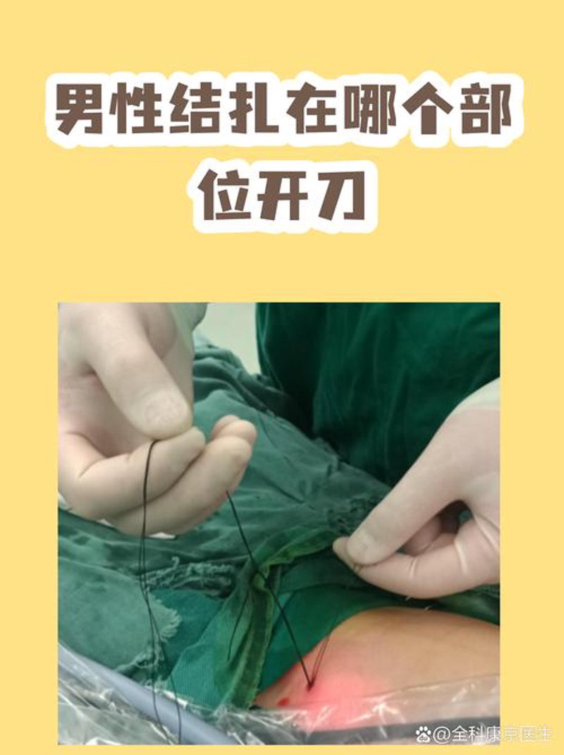 绝育手术
